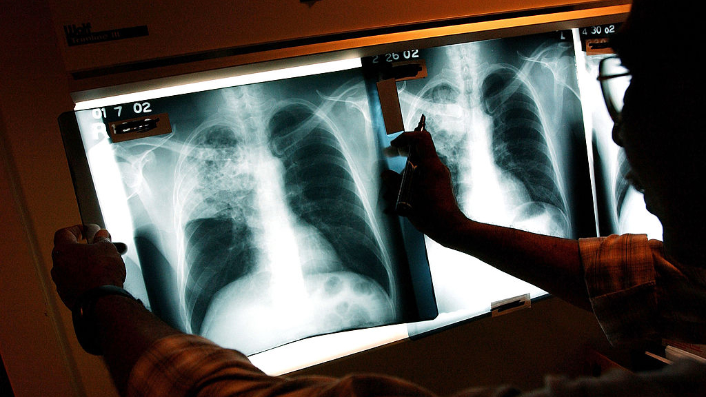 2 active tuberculosis cases traced to San Francisco strip club — KTVU FOX 2 Bay Area, St. Helena Health news